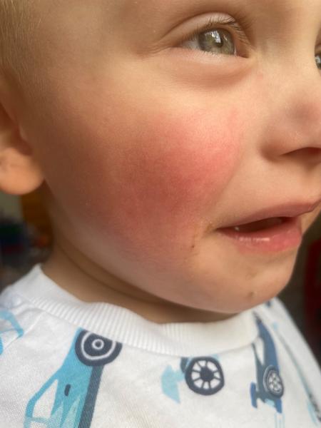 Máte zkušenosti s červenými uši, tvářemi a vyrážkou?