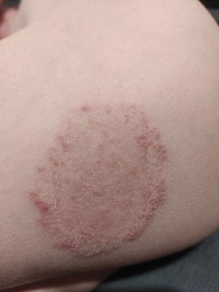 Doplnění fotografie k dotazu "Vyrážka"