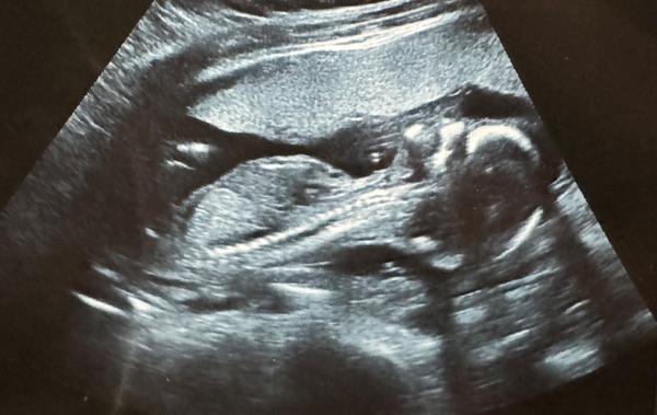 Jak zjistit pohlaví miminka ve 17. týdnu?