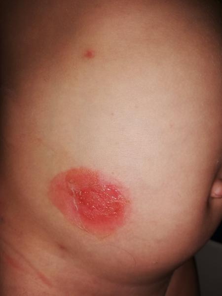 Impetigo - může to být?