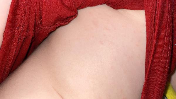 Vyrážka u tříletého dítěte. Jak to řešit?