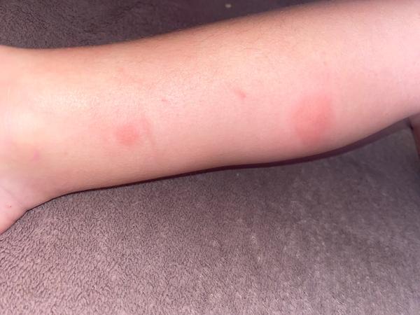 Je to vyrážka? Co značí skvrny na kůži dětí?