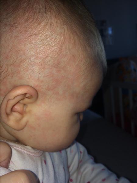 Vyrážka - je to alergie nebo potničky? 