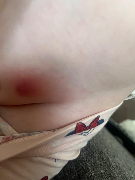 Pupínek na intimních partiích u dítěte. Jaké jsou příčiny?