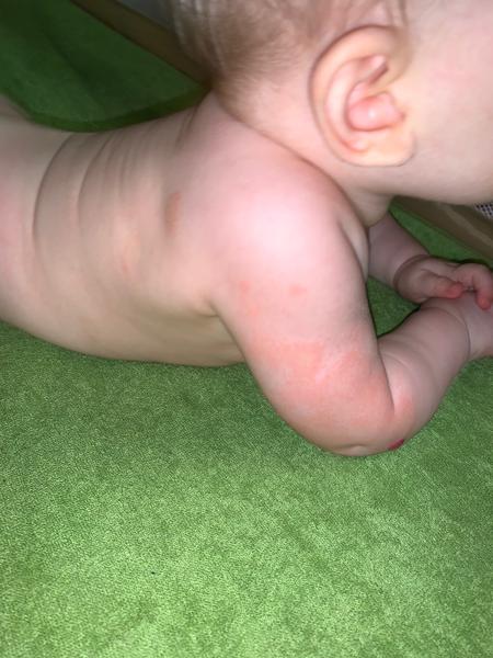 Ekzém nebo kvasinka?