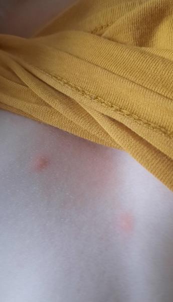 Varilrix očkování: Je možné se nakazit neštovicemi?