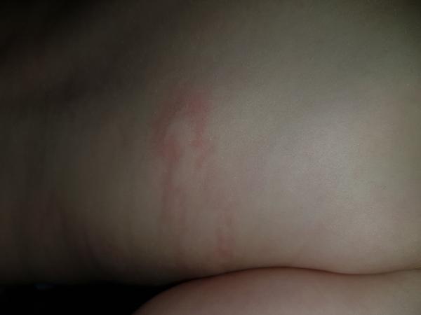 Vyrážka. Co by to mohlo být?