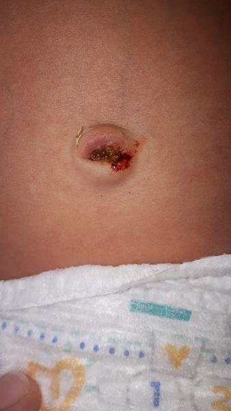 Odpadnutý pupeční pahýl. Nechat tak nebo jet k dr.?