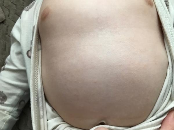 Vyrážka - 3,5m. miminko. Může se takto projevit reakce na potraviny?