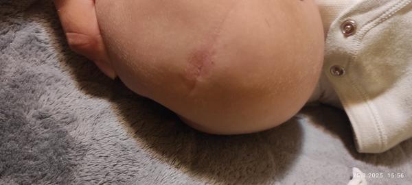 Jak pomoci miminku s vyrážkou a ekzémem?