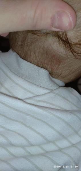 Neštovice. Mohly by to být?