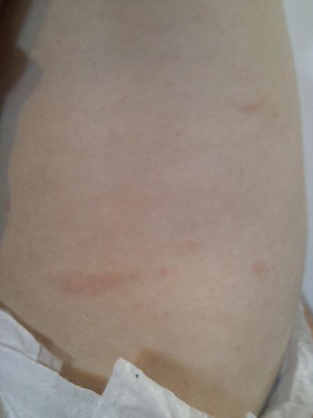 Pupínky u ročního syna. Jsou to štípance?