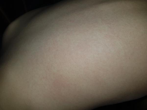 Nevíte, co způsobuje vyrážku u dětí?