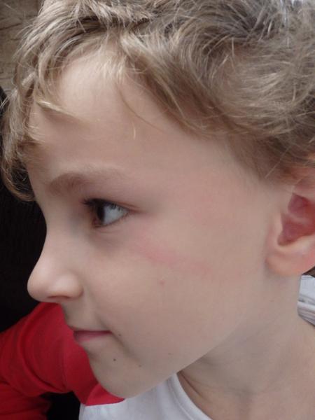 Fleky v obličeji. Co by to mohlo být?