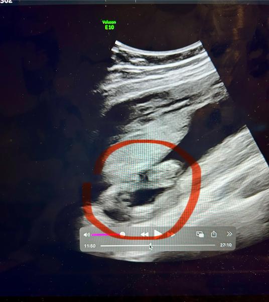 Jak rozpoznat pohlaví dítěte na ultrazvuku?