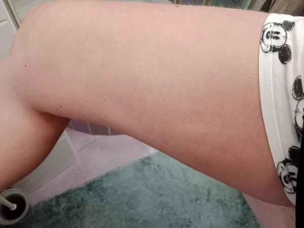 Záhadné modré fleky na těle. Jak na ně reagovat?