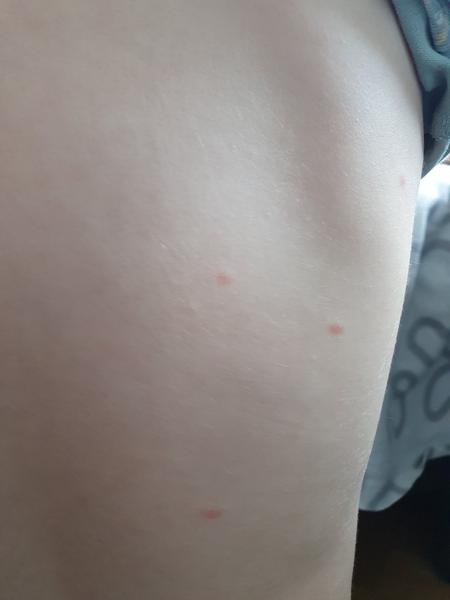 Pupínky na těle dítěte. Je to alergie nebo potničky?