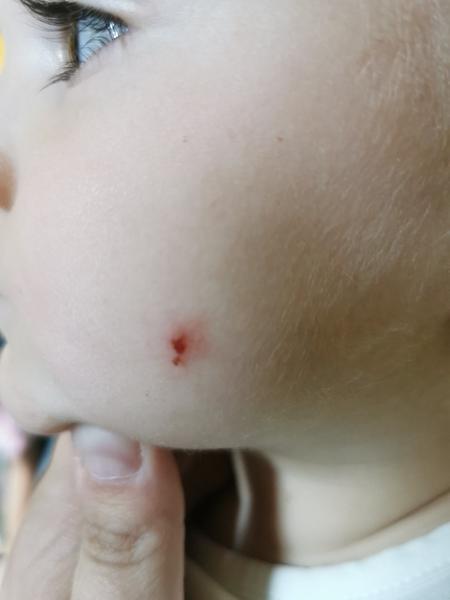 Neštovice u dětí jen jako jeden malý pupínek na tváři. Je to možné?