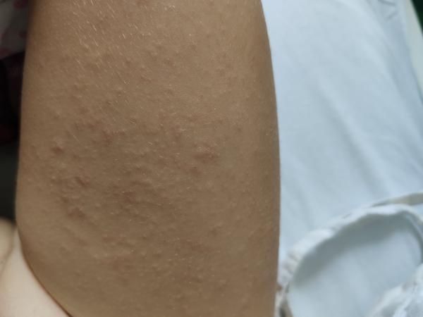 Ekzém? Jak prosím postupovat?