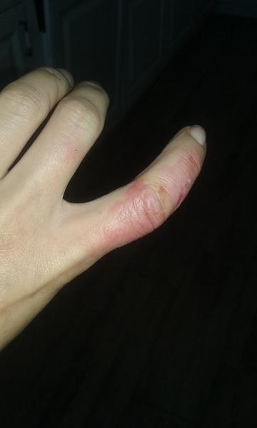 Bolestivé a svědivé prsty: Co způsobuje vyrážku?