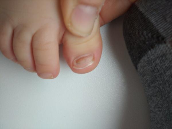 Hnědý flek pod nehtem. Co by to mohlo být?