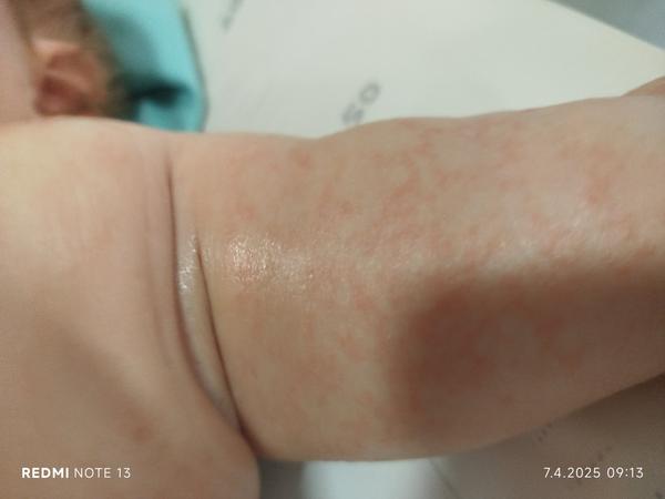 Vyrážka u dcerky. Jaké jsou možné příčiny a řešení?