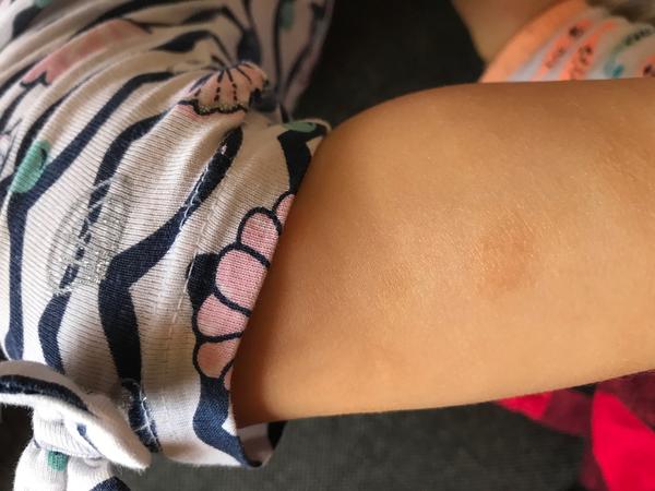 Atopický ekzém. Mohl by to být?