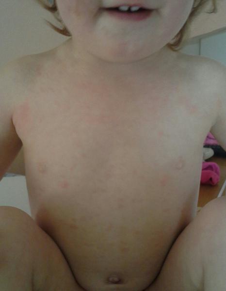 Alergická reakce? Dcera se osypala na zádech a bříšku