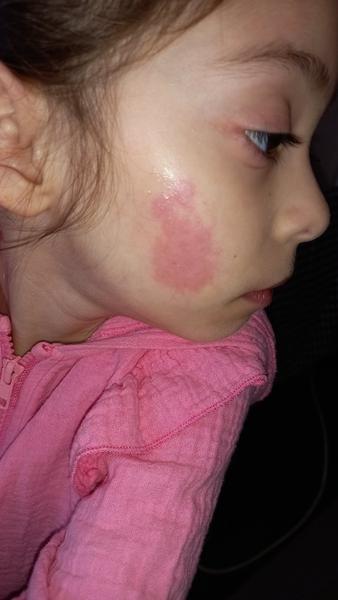 Alergie na Erythromycin u dcery? Zkušenosti a radu prosím!