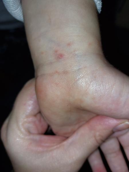 Jak řešit svědivé pupínky na rukou dítěte?