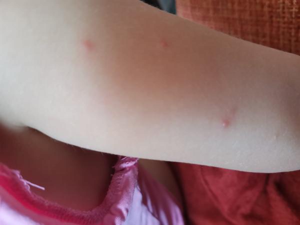 Jsou tyto příznaky opravdu neštovice?