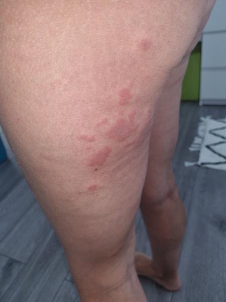 Kožní vyrážka po dovolené v Tunisku. Jak postupovat?