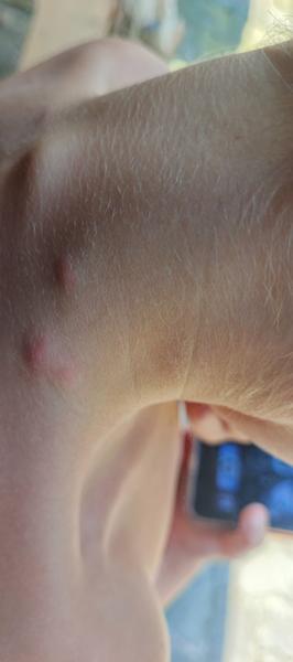 Pupínky na zádech u dítěte: Co to může znamenat?