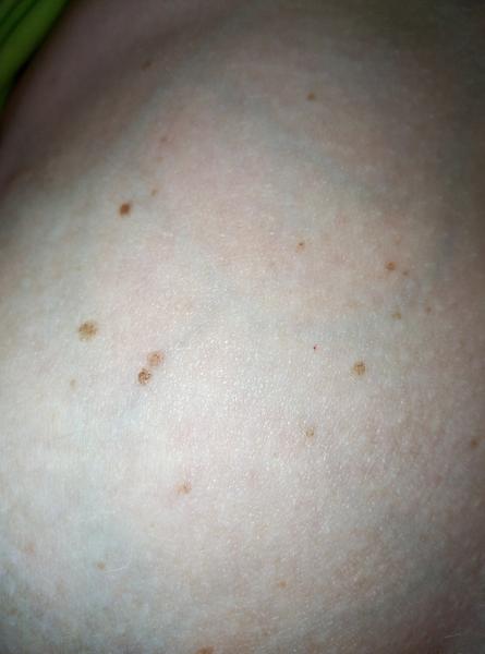 Znaménka na prsu. Hormonální změna nebo zajít na kožní?