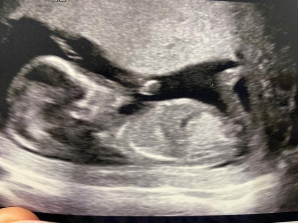 Holčička nebo chlapeček? Tipy a názory maminek