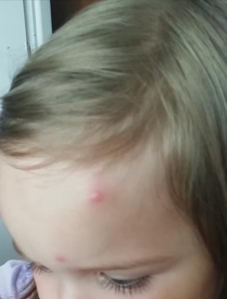 Má moje dcera vyrážku nebo štípanec z dovolené?