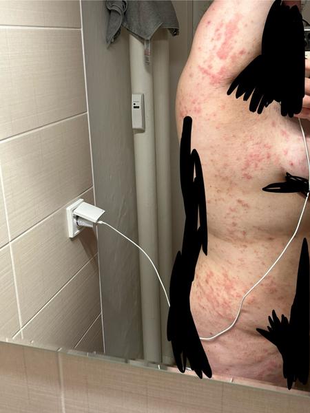 Nezabírají léčby na svědivou vyrážku. Co dělat?