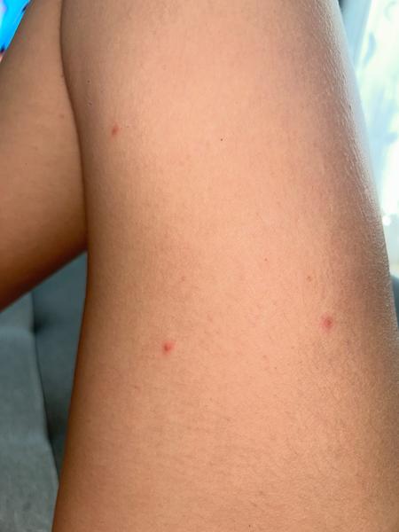 Červené pupínky po těle. Co by to mohlo být?