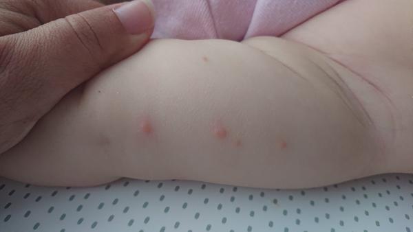 Pupínky na obličeji u miminka: Komáří štípnutí nebo alergie?