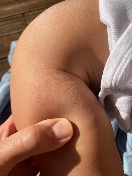 Vyrážka na třísle a na stehně u 9m. dítěte. Poradíte, prosím?