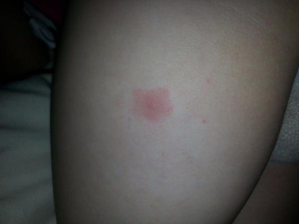 Mohly by to být neštovice?