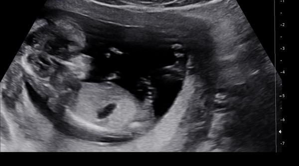 Dokáže lékař odhadnout pohlaví v 13. týdnu?