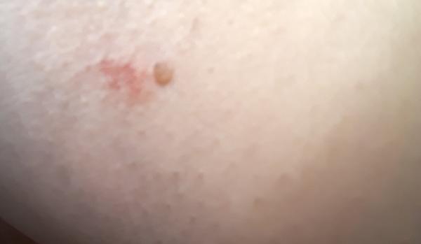 Co to je? Piha nebo klíště?