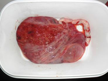 Placenta