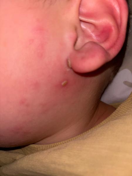Může se jednat o impetigo?