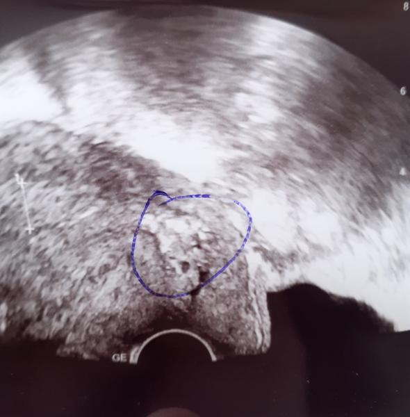 Nález na děložním hrdle. Co by to mohlo být?