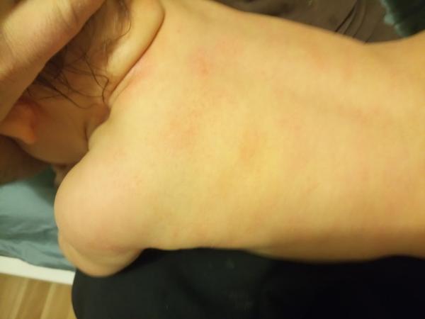 Co to může být za vyrážku u 10měsíční dcery? Je bez teplot