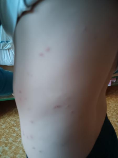 Co způsobuje svědící vyrážku na trupu a nohách?