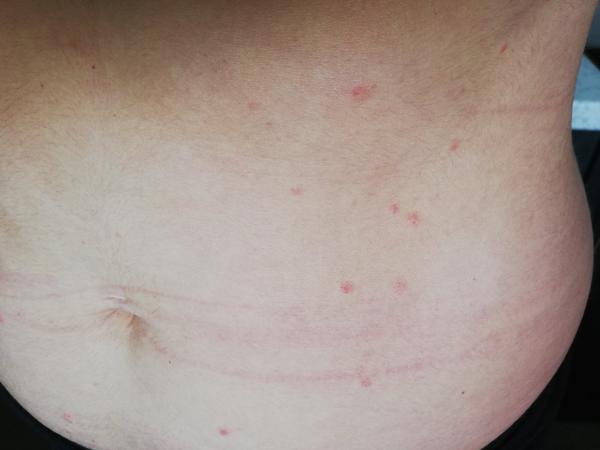 Neštovice podruhé ve 30 letech. Mohly by to být?