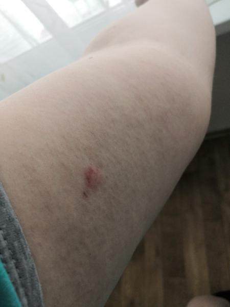 Červené fleky na nohách. O co by se mohlo jednat?